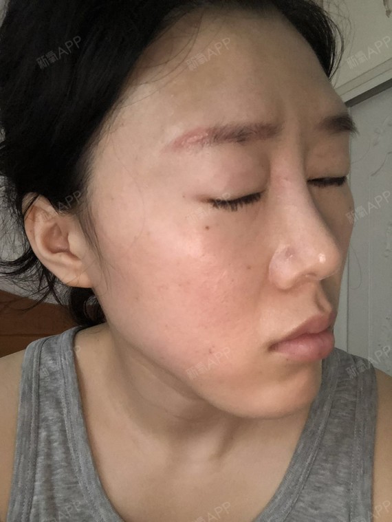 总体来说,手术部位恢复得_圈子-新氧美容整形