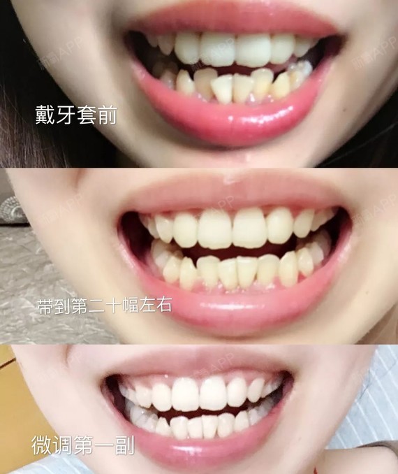 戴牙套之前,医生可能会让你戴1-3天的体验保持器, 这个「从无到有」的