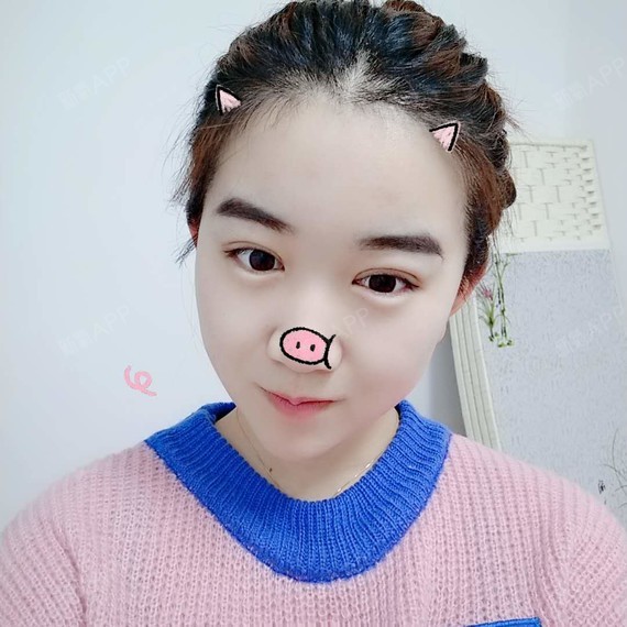 卡卡卡的卡卡切开双眼皮第159天美丽日记-新氧