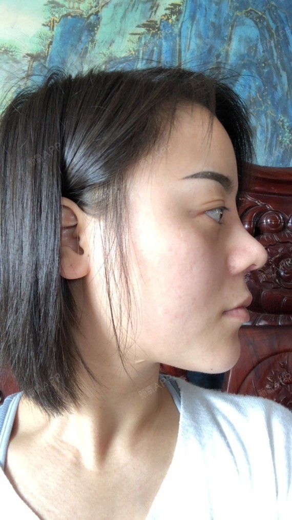 山根鼻头虽_圈子-新氧美容整形