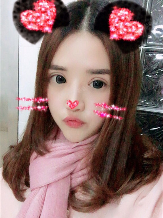 苏州黄金微针好不好_效果图_芭蕉jj黄金微针术后第90天_新氧美容整形