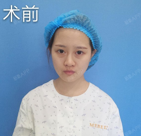 南京医美探店|95后老阿姨眼部整形经历◇体验