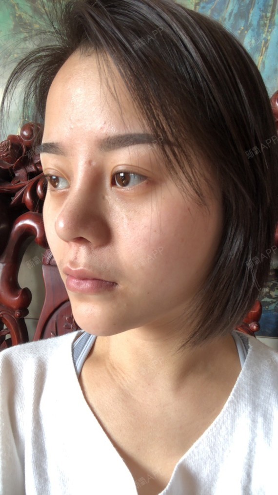 术后第15天拆完线的鼻子就是这个样子的.