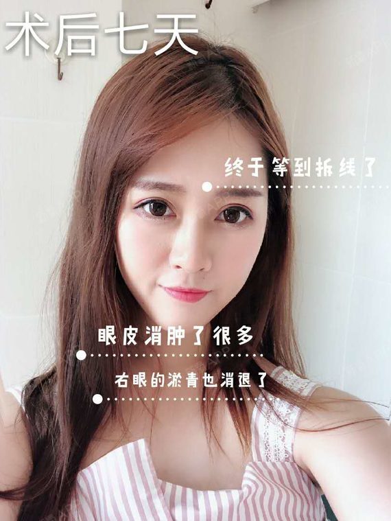 南京医美探店|95后老阿姨眼部整形经历◇体验