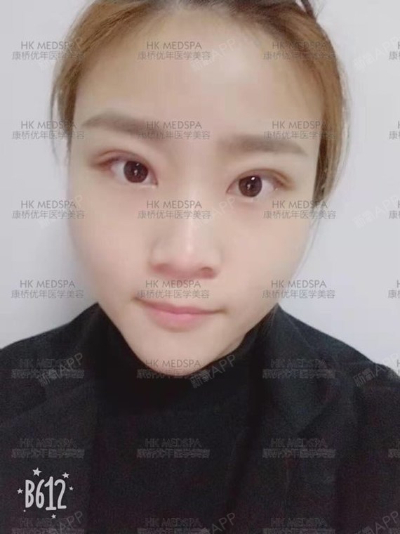 时间过得好快,拆线之后的双眼皮恢复得特别快,每天消肿的程度都不一样