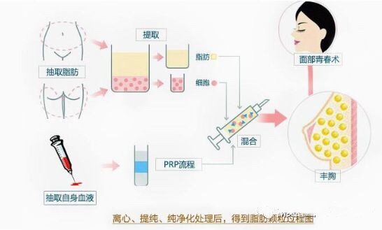 什么是PRP?PRP(PlateletRichPlasma)中文的意