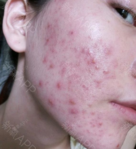 一个星期过去了,疙瘩有变小一点,看上去似乎变红了一_圈子-新氧美容