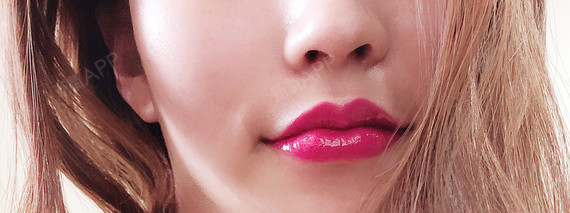 医院:韩国欧佩拉项目:玻尿酸m唇 嘴角上扬肉毒素注_圈子-新氧美容整形