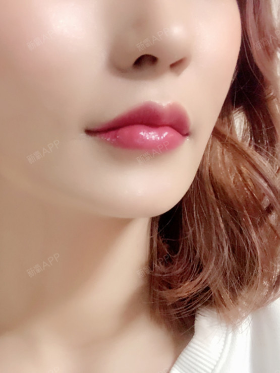 医院:韩国欧佩拉项目:玻尿酸m唇 嘴角上扬肉毒素注_圈子-新氧美容整形