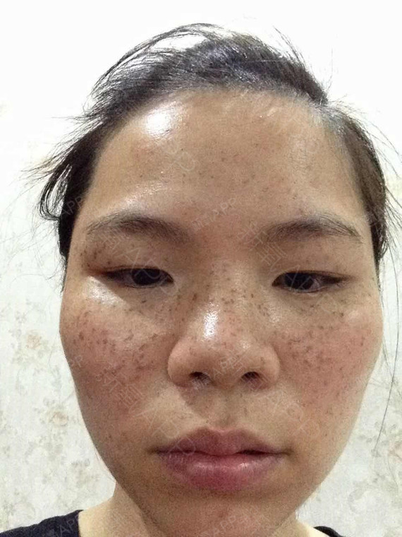 第二次皮秒后的样子现在脸上已经都结痂了,静静的等待_圈子-新氧美容