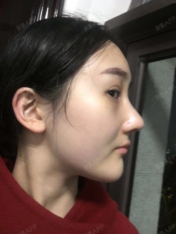 鼻子整体很大气呢,鼻头丰满,轮廓清晰,鼻尖看上去也_圈子-新氧美容