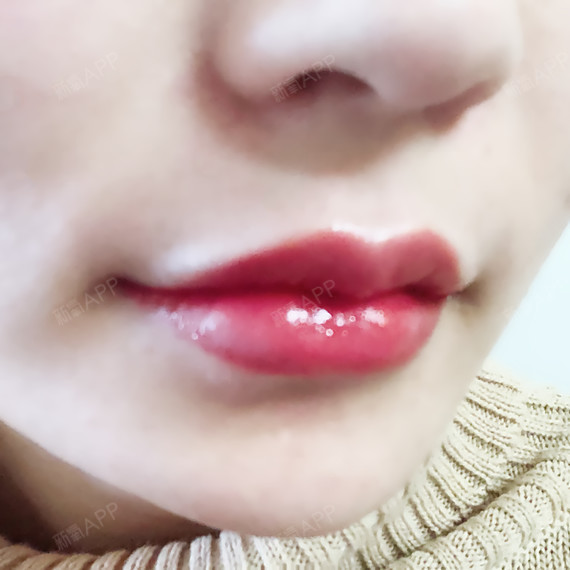 医院:韩国欧佩拉项目:玻尿酸m唇 嘴角上扬肉毒素注_圈子-新氧美容整形