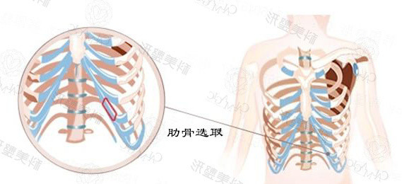 肋软骨隆鼻会变形吗 取出来的肋软骨还 新氧美容整形