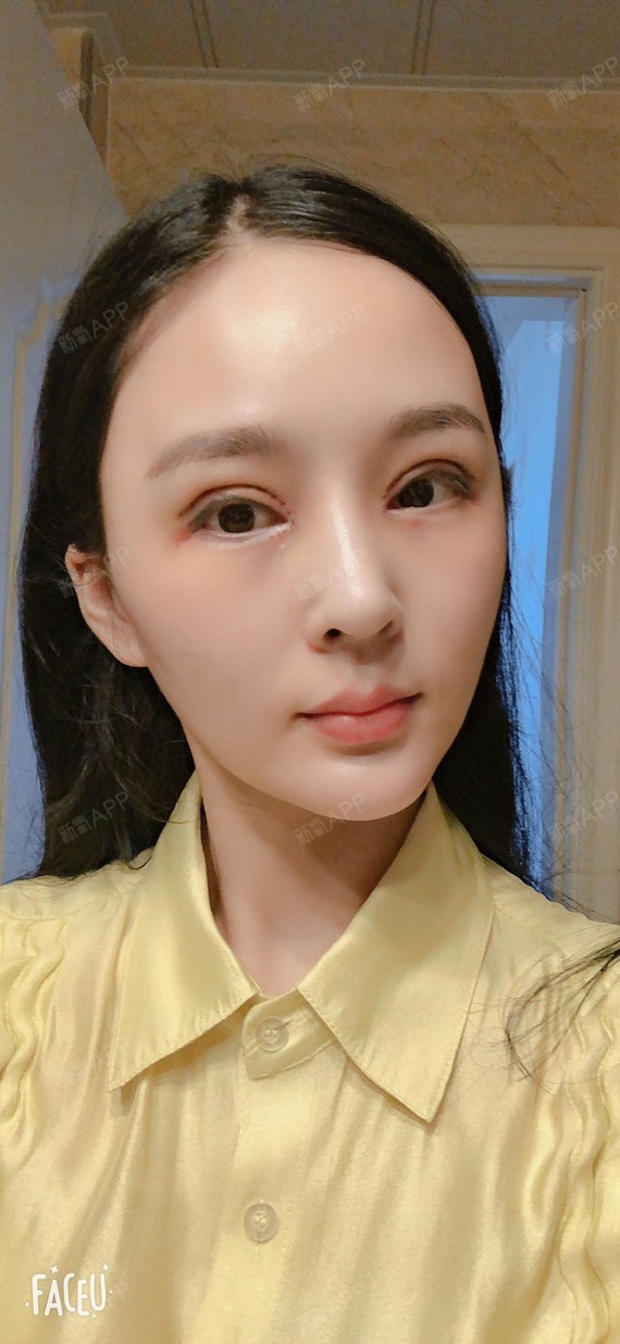 看以前的照片,改善还是挺大的,个人经验,如果第一次做双眼皮,一定要