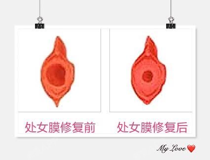 你好,不管是因为什么原因导致处女膜破裂,只要放正心_圈子-新氧美容