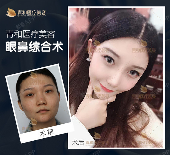 建议到正规的专业的整形医院手术,采用自体软