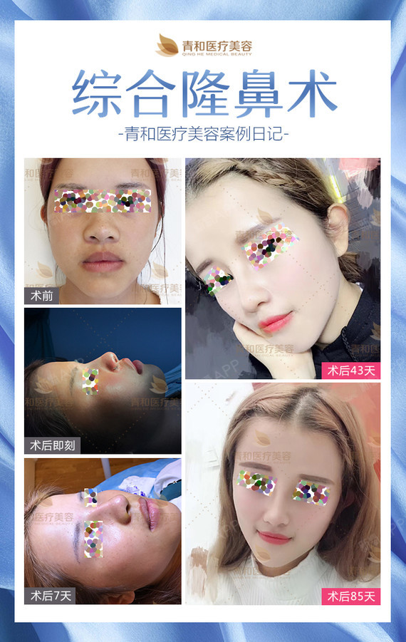 建议到正规的专业的整形医院手术,采用自体软