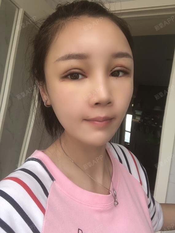 自体脂肪全脸填充好不好_效果图_善绢子自体脂肪全脸填充术后第13天