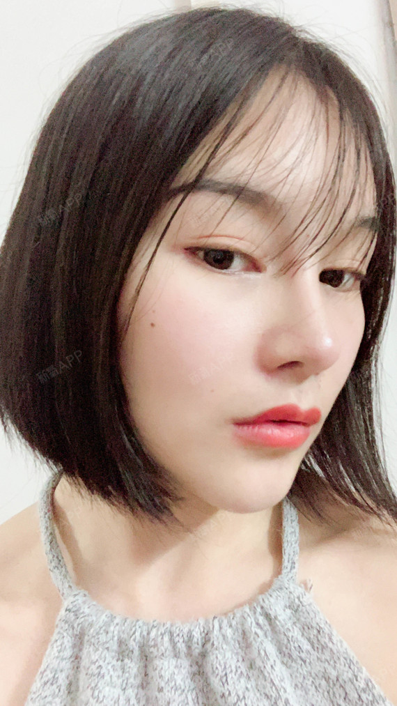 深圳膨体隆鼻好不好_效果图_alittlesun膨体隆鼻术后第45天_新氧美容