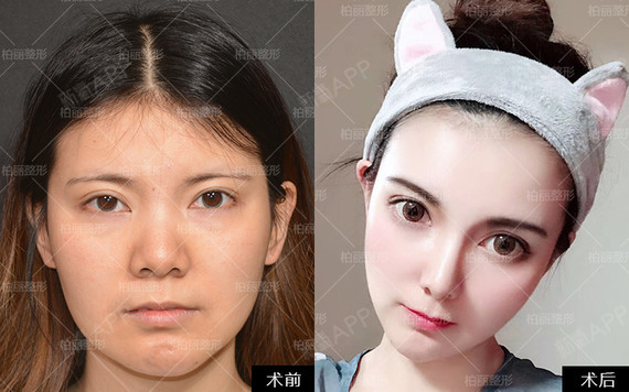 有一定的支撑力度,是可以进行鼻小柱支撑,延长抬高鼻尖的效果