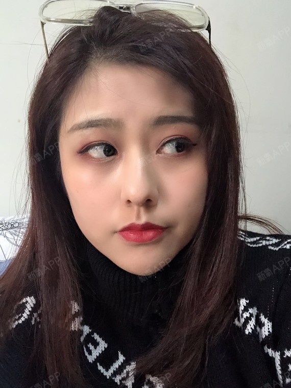 为什么有的人线雕后脸变形、线不吸收?线雕可