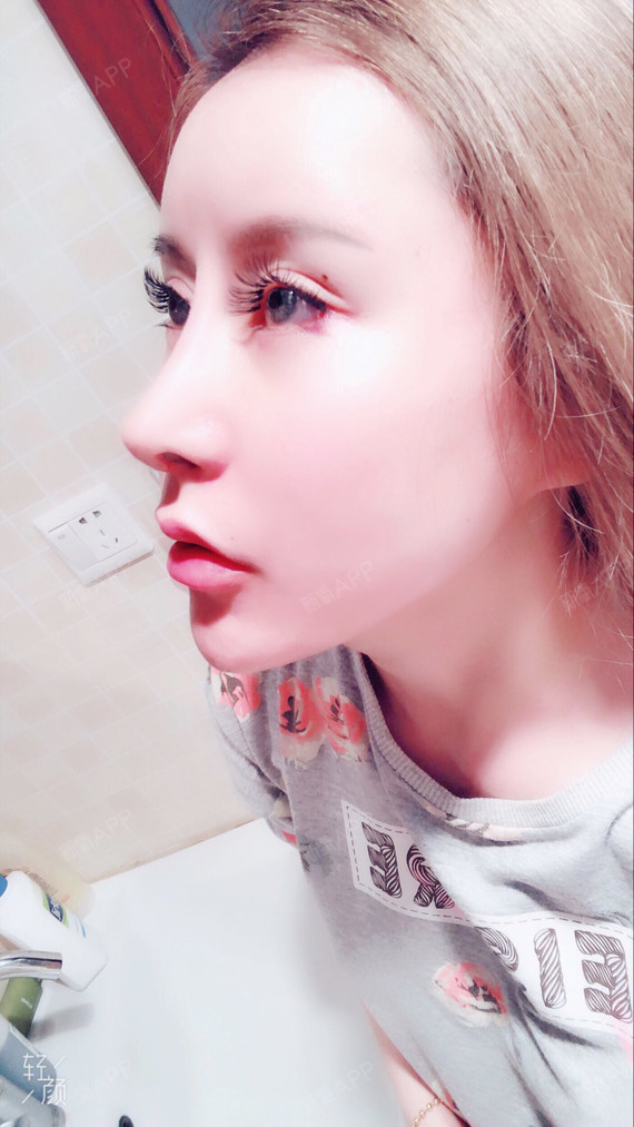 【沈阳美联致美】【异体骨隆鼻】哈喽,宝宝们~我又来_圈子-新氧美容
