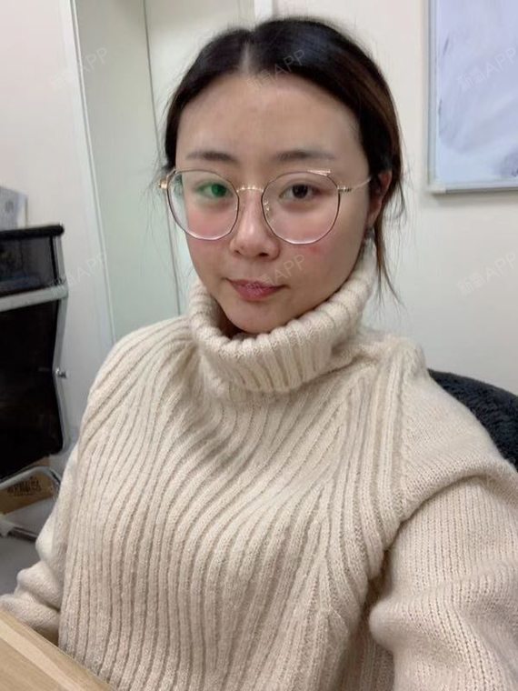 长沙红蓝光祛痘好不好_效果图_氧气z96aa红蓝光祛痘术后第2天_新氧