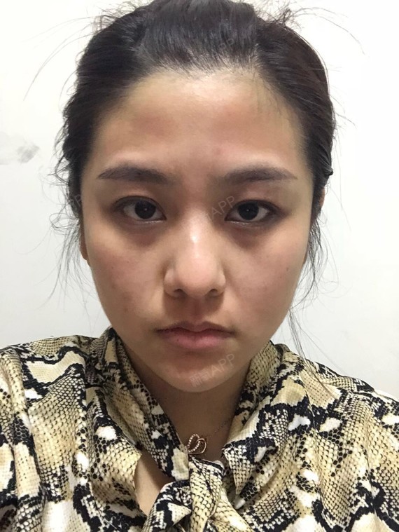 为什么有的人线雕后脸变形、线不吸收?线雕可