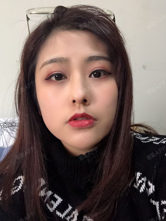 为什么有的人线雕后脸变形、线不吸收?线雕可