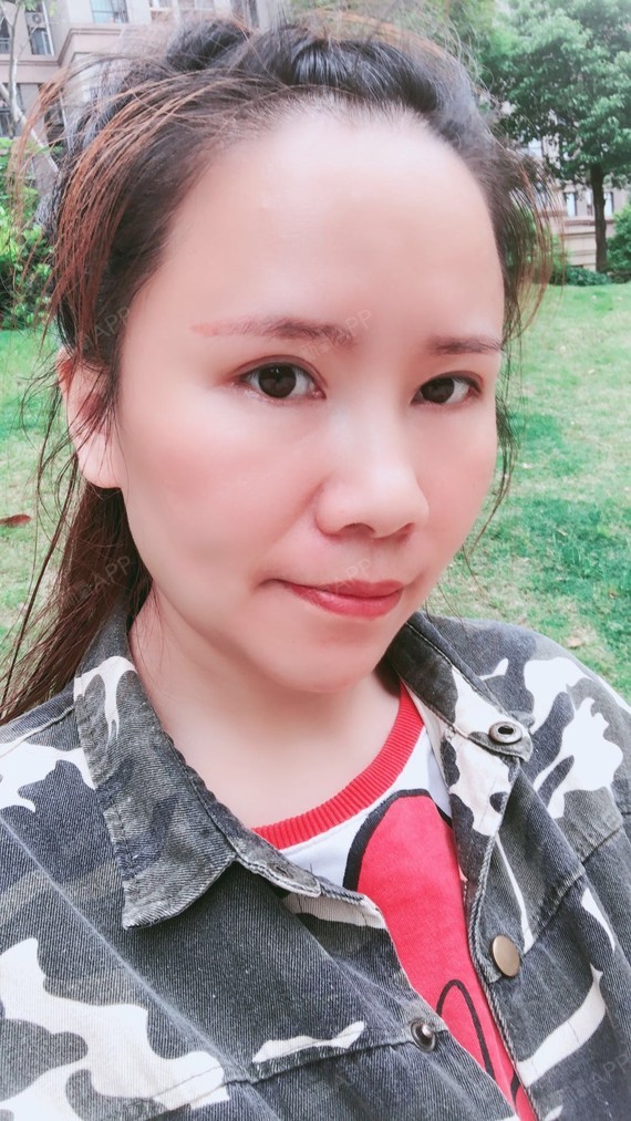 武汉美基元切眉术第77天