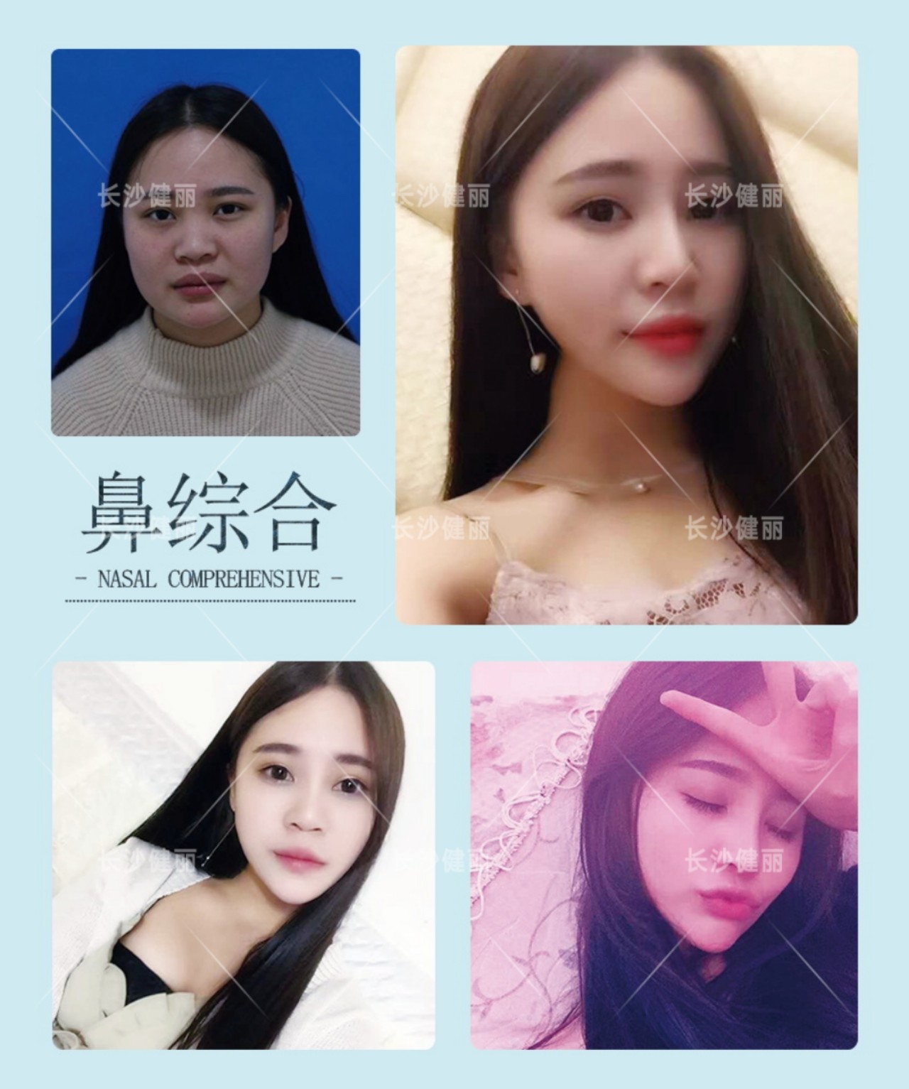 用自体脂肪隆鼻会有什么副作用吗 会伤 新氧美容整形