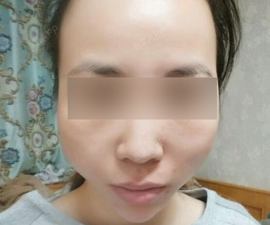 做线雕脸颊多久后好看?线雕大v线提升面部颧骨变宽了怎么办?