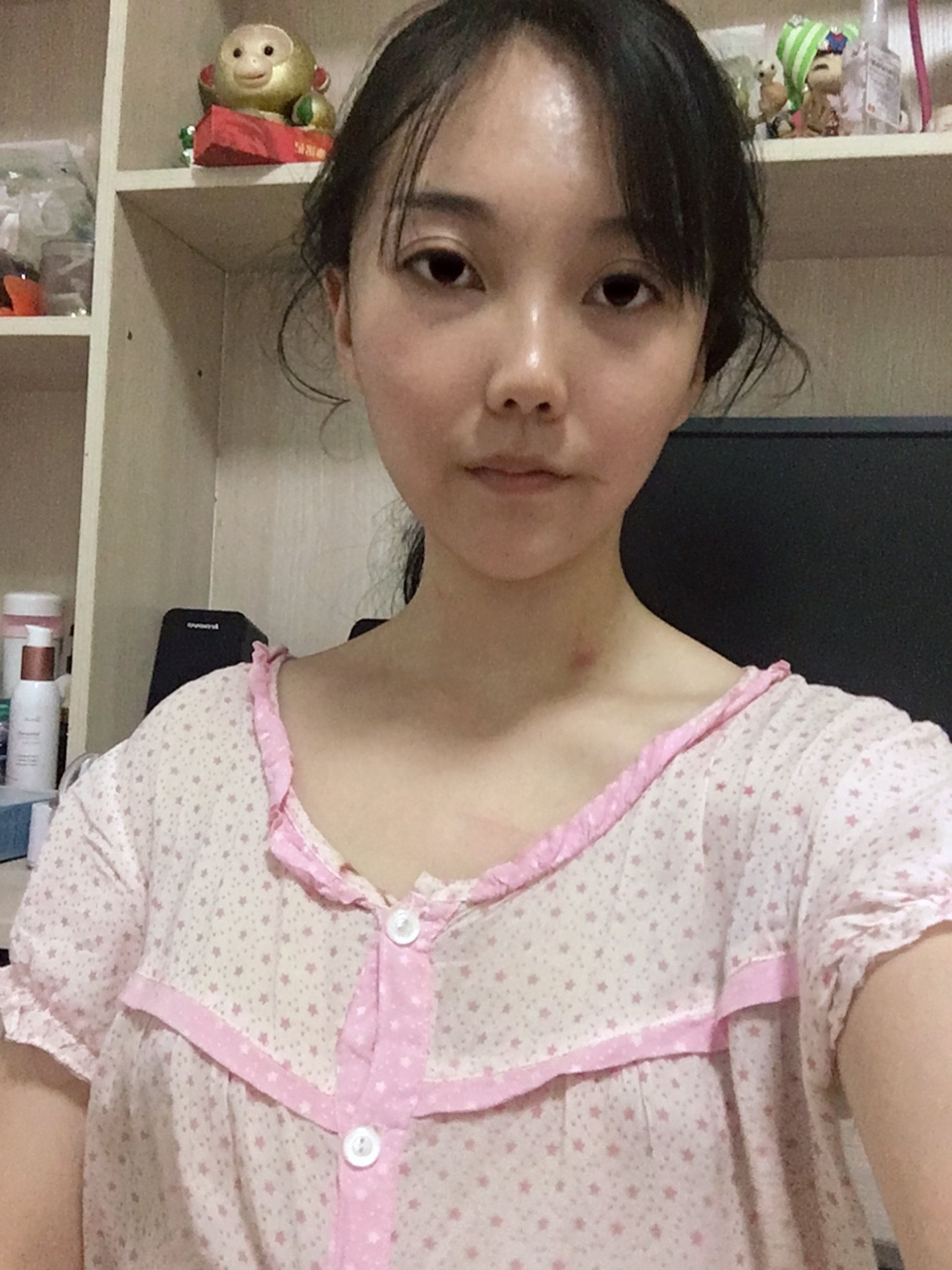 严重肿胀期自体脂肪隆胸第1天 · 第1篇日记