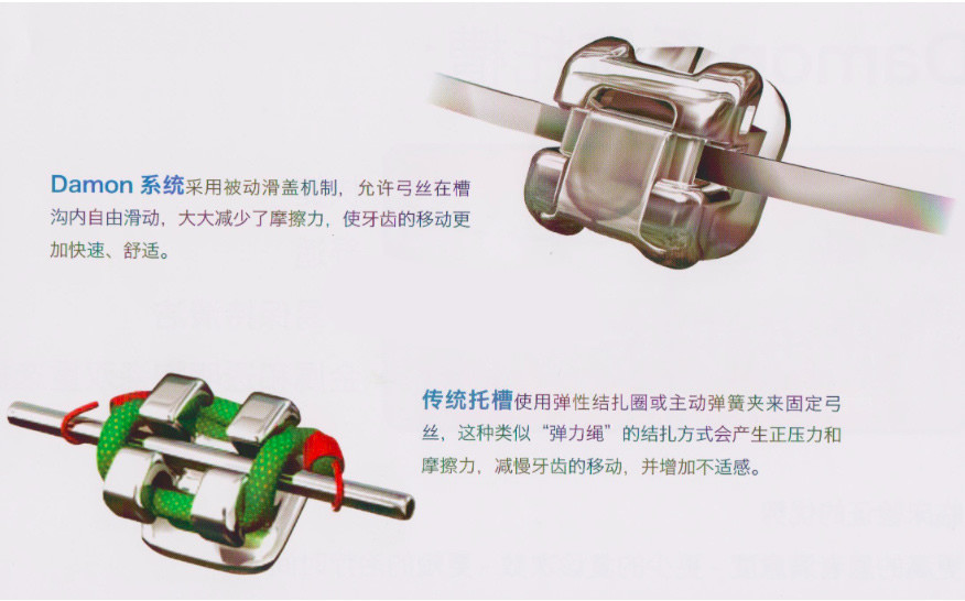 矫正牙齿需要拔四颗牙,想知道陶瓷的牙套自锁和非自锁有什么区别呢?