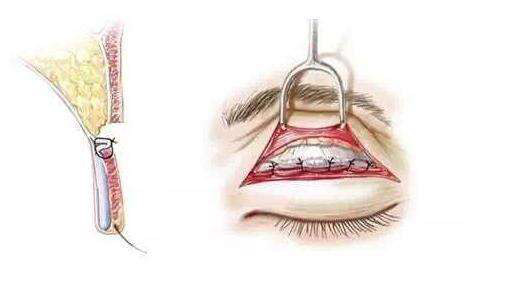 全切双眼皮比其他双眼皮手术的优势是什么?