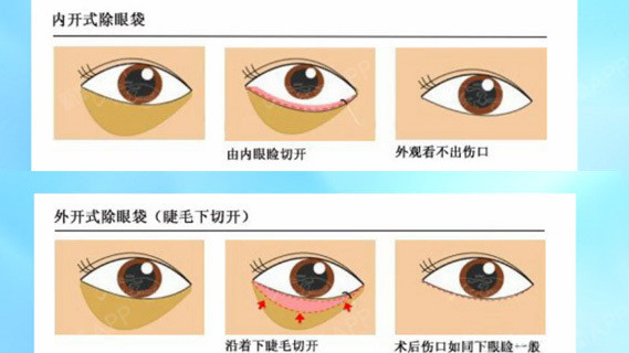 內切祛眼袋:這個是祛眼袋常見的方式,內切眼袋從眼睛的結膜入路,切口8