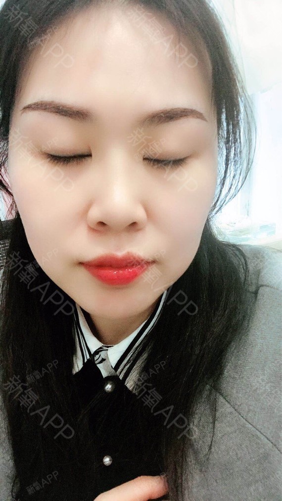 纹眉术后3天~~3天没洗头,眉毛已经在掉痂啦!看到_圈子-新氧美容整形