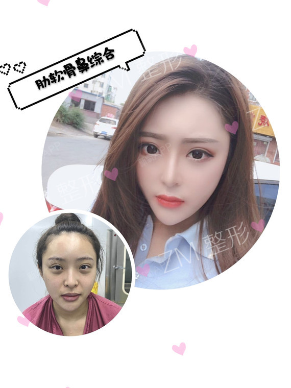 你好,感谢邀请!隆鼻手术我一般会取右侧第6、