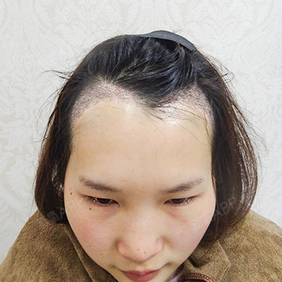 种植发际线项目术后第2天