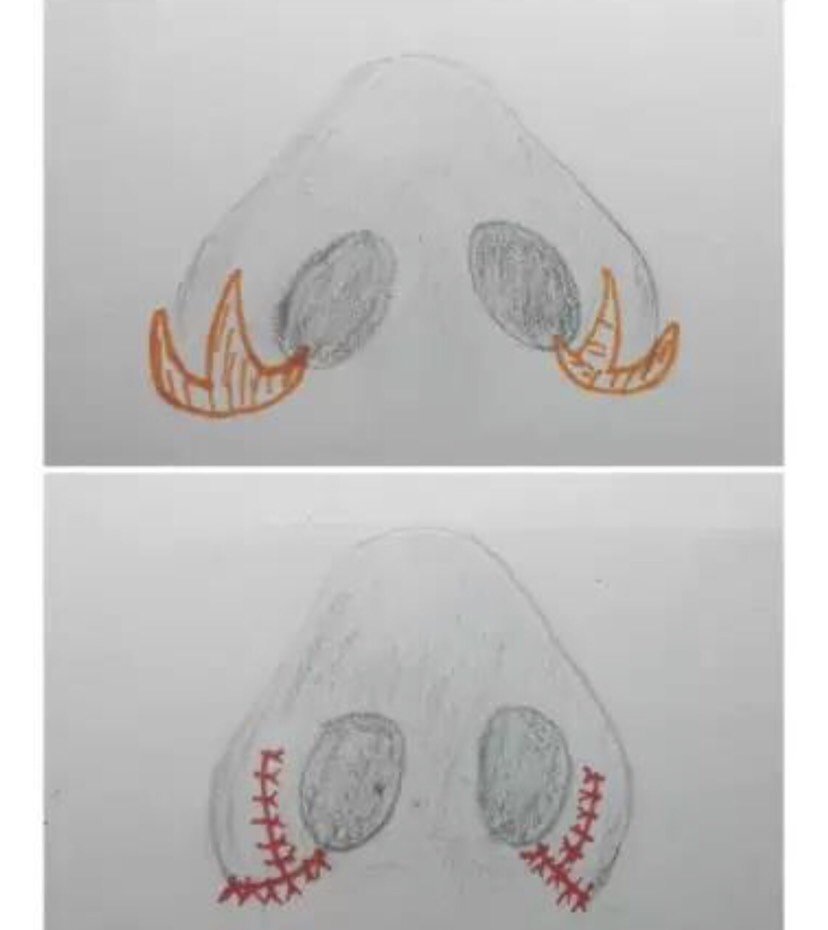 建议收藏——鼻翼缩小 内切or外切