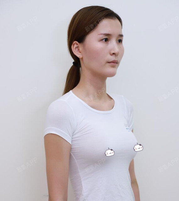 爱思特假体隆胸因为从小胸部发育不良的关系让我一度感到很自卑就是