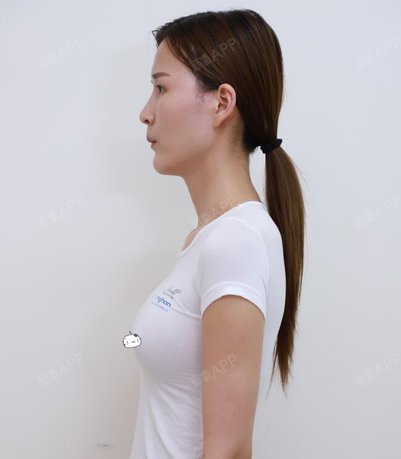 爱思特假体隆胸因为从小胸部发育不良的关系让我一度感到很自卑就是