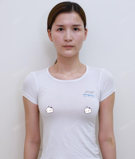 爱思特假体隆胸因为从小胸部发育不良的关系让我一度感到很自卑就是