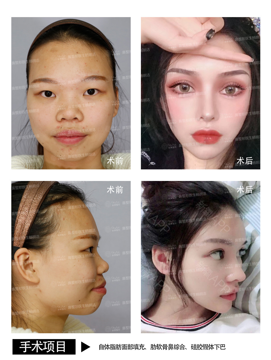 想做鼻子 有朋友推荐了韩国的原辰 纯 新氧美容整形