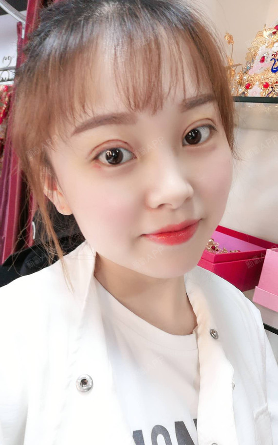 今天是我割完双眼皮的第七天,眼睛渐渐的消肿了,看着_圈子-新氧美容