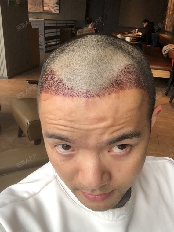 今天是植发的第二天,到医院去拆纱布了.