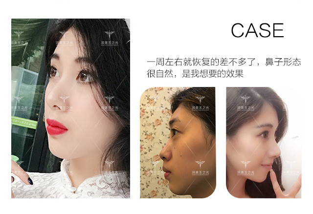 您好请问线雕隆鼻如何去除 新氧 专业医美服务平台