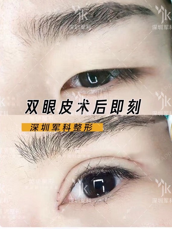 首页 此页面仅支持预览 Avatar 刘月更 364篇日记 您好很高兴帮到您 对于每一个美容外科医生来说 失败双眼皮 这一标准的确立至今没有一个明确和标准的说法 各个医生的说法也是比较笼统和模糊 通常 对于一个普通求美者而言 双眼皮术后形态让自己和