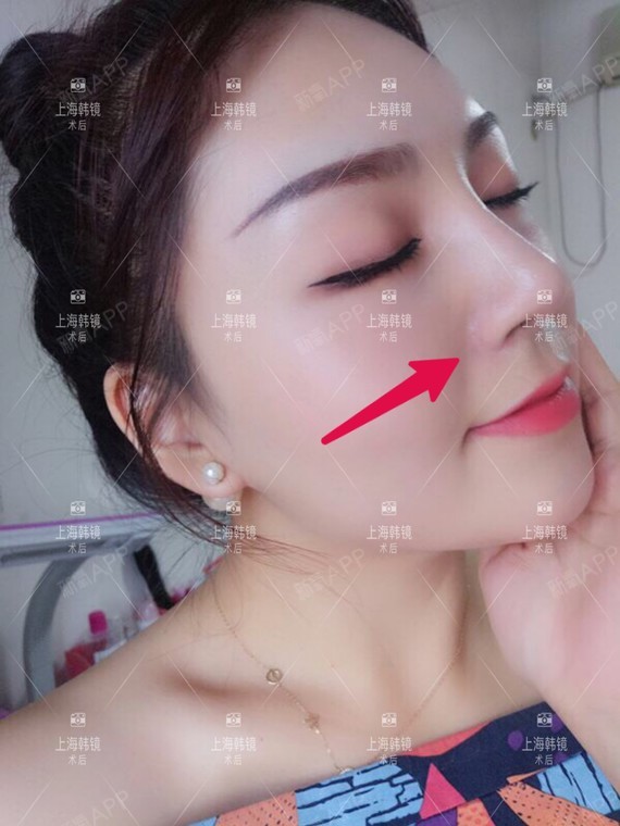 1,鼻翼缩小术后的24小时内,鼻翼缩小术受术者的面部会肿胀,感到鼻子