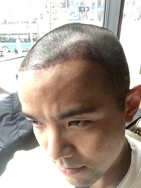 今天是植发的第二天,到医院去拆纱布了.